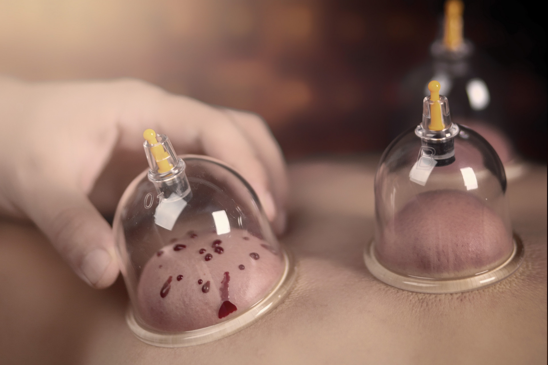 Exploring the Use and Misconceptions of Cupping Therapy