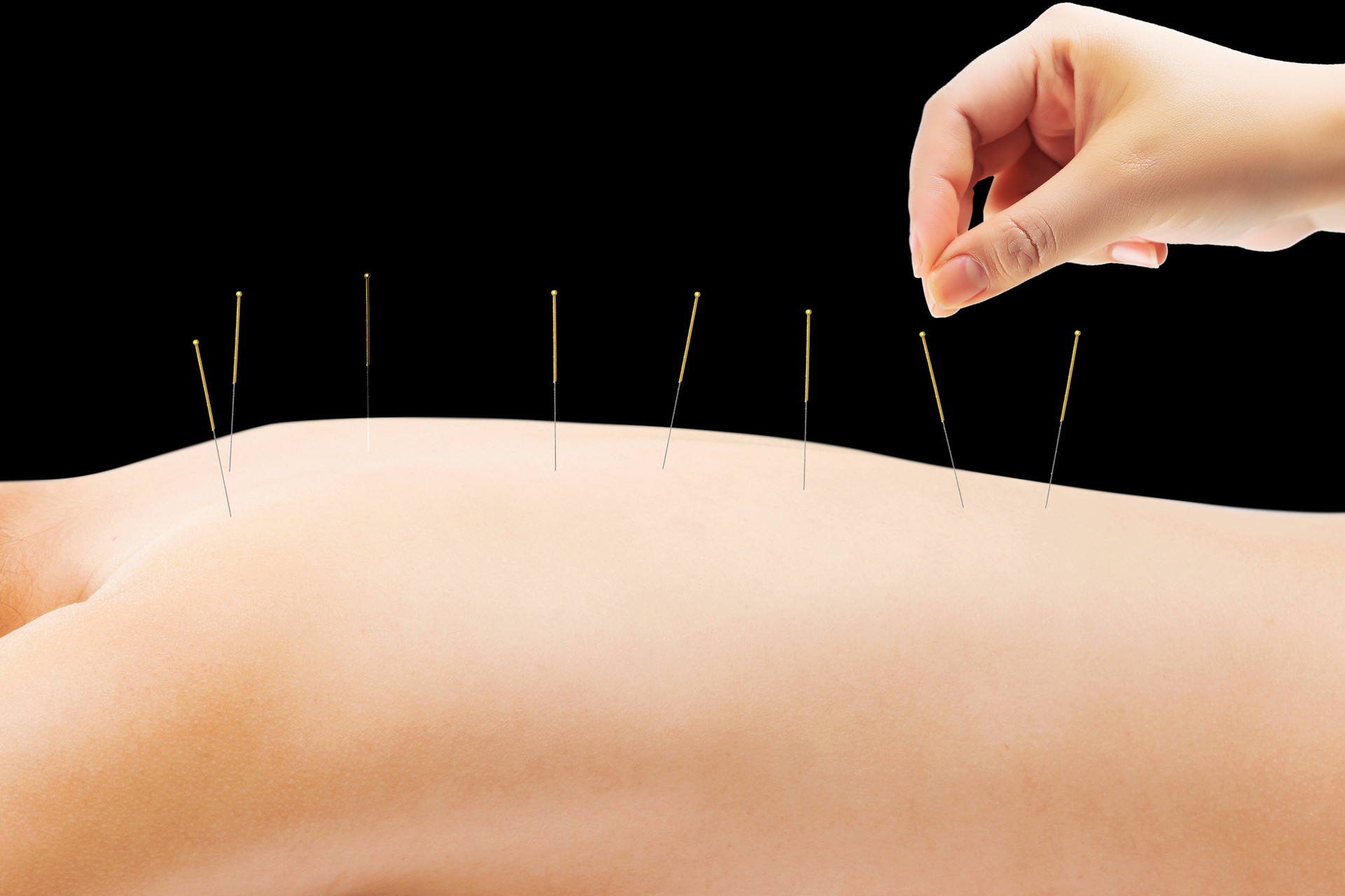 Acupuncture: An Effective Treatment for Bronchial Asthma