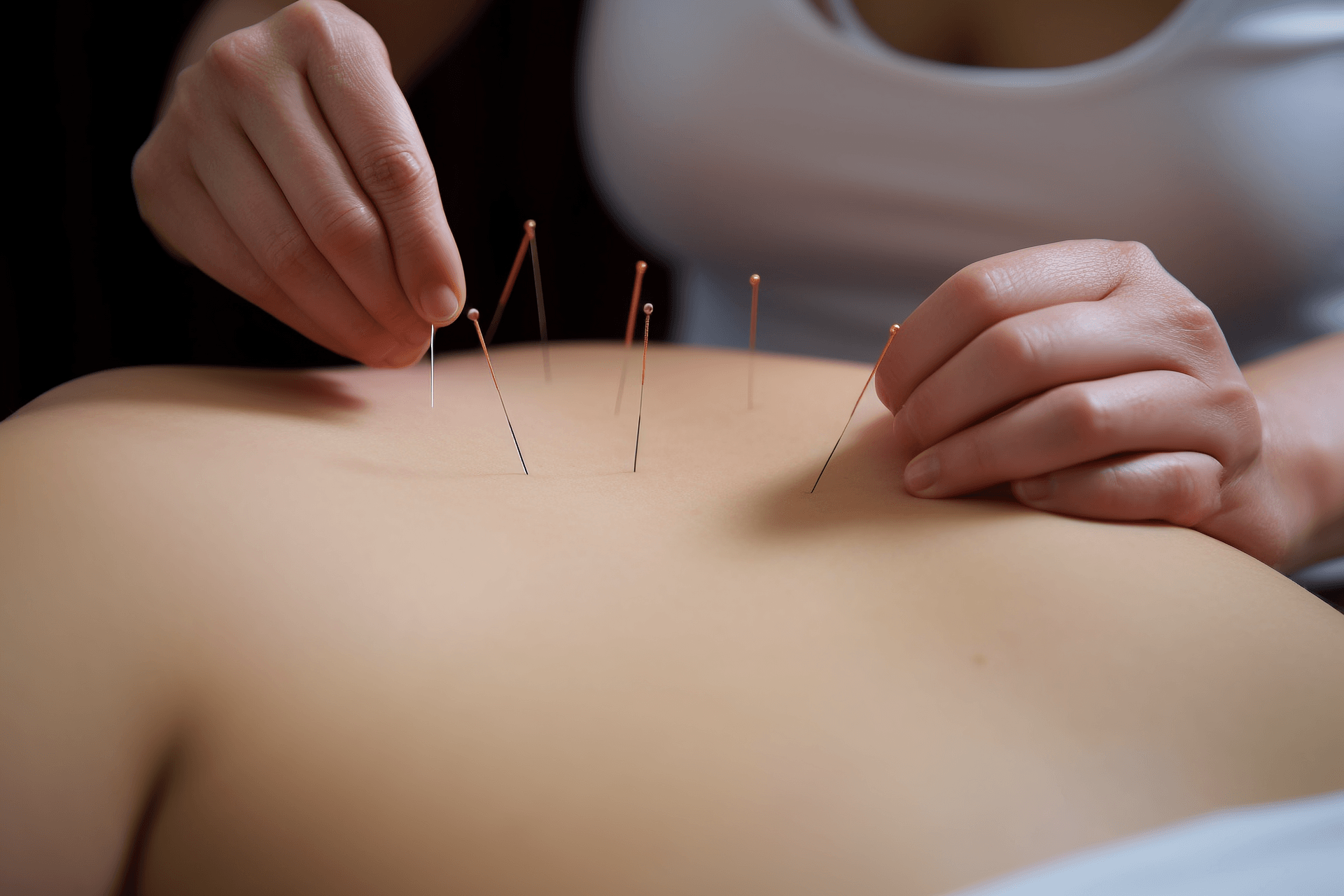 Intradermal Needle Therapy: A Long-Term Approach to Acupuncture