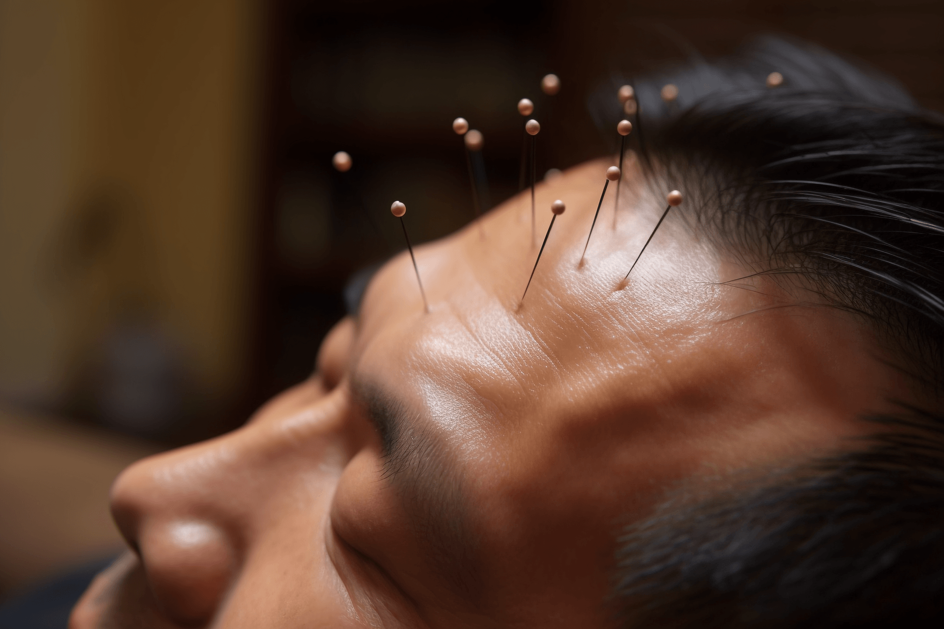 The Therapeutic Effects of Traditional Chinese Medicine Acupuncture: Promoting Health and Balance