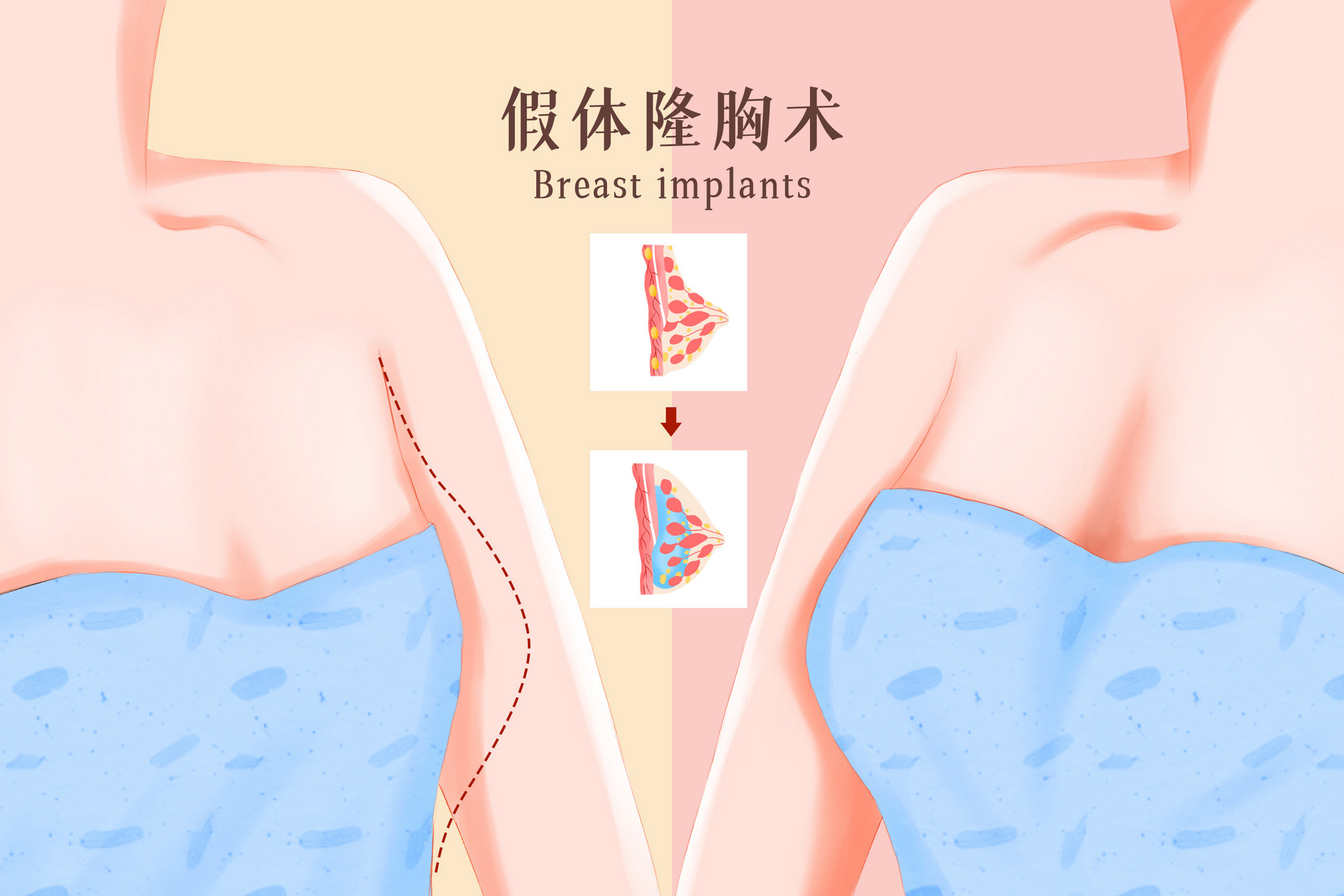 Natural Methods for Breast Enhancement in Adolescent Girls: Traditional Chinese Medicine Approach